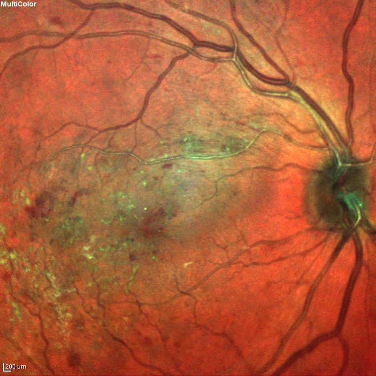 Retinopatia-diabetica.jpg